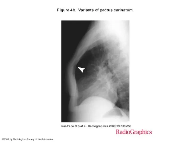 Figure 4b. Variants of pectus carinatum. Restrepo C S et al.