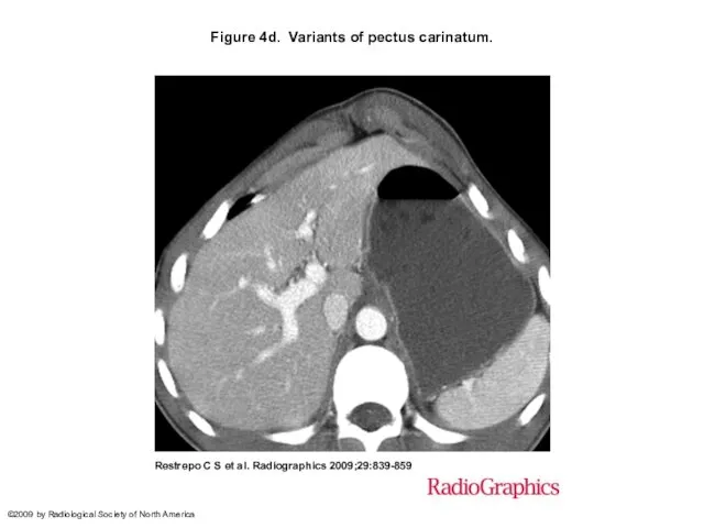 Figure 4d. Variants of pectus carinatum. Restrepo C S et al.