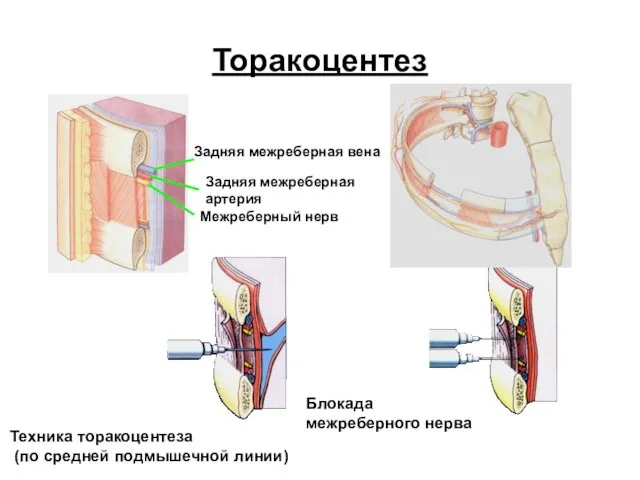 Торакоцентез Задняя межреберная вена Задняя межреберная артерия Межреберный нерв Техника торакоцентеза