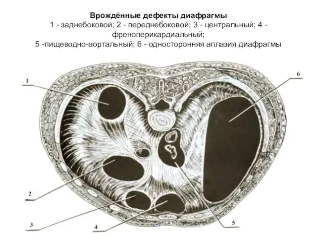 Врождённые дефекты диафрагмы 1 - заднебоковой; 2 - переднебоковой; 3 -