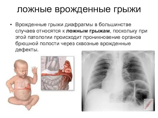 ложные врожденные грыжи Врожденные грыжи диафрагмы в большинстве случаев относятся к