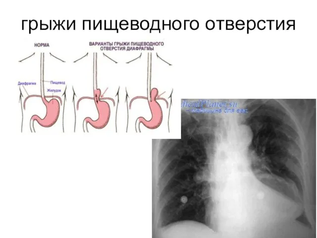 грыжи пищеводного отверстия