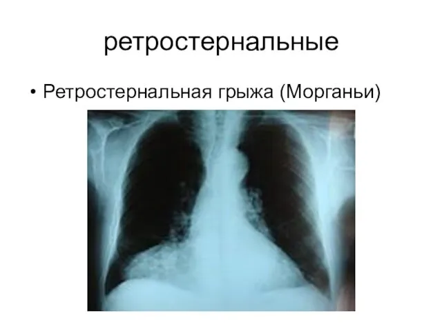 ретростернальные Ретростернальная грыжа (Морганьи)