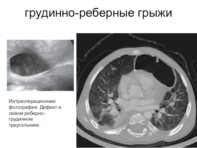 грудинно-реберные грыжи Интраоперационная фотография. Дефект в левом реберно-грудинном треугольнике.