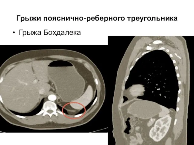 Грыжи пояснично-реберного треугольника Грыжа Бохдалека