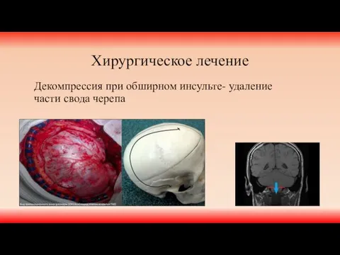 Хирургическое лечение Декомпрессия при обширном инсульте- удаление части свода черепа