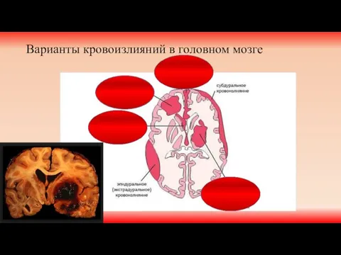 Варианты кровоизлияний в головном мозге