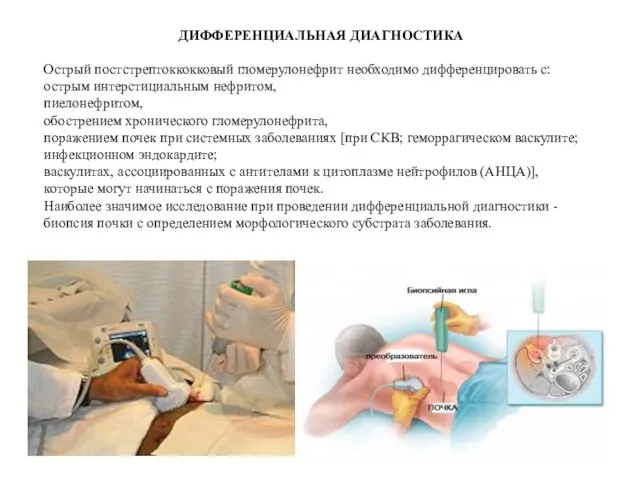 ДИФФЕРЕНЦИАЛЬНАЯ ДИАГНОСТИКА Острый постстрептоккокковый гломерулонефрит необходимо дифференцировать с: острым интерстициальным нефритом,