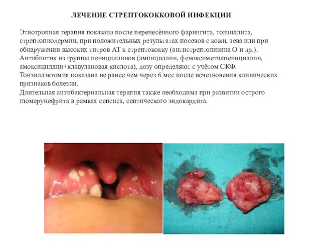 ЛЕЧЕНИЕ СТРЕПТОКОККОВОЙ ИНФЕКЦИИ Этиотропная терапия показана после перенесённого фарингита, тонзиллита, стрептопиодермии,