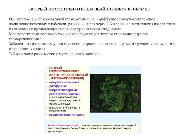 ОСТРЫЙ ПОСТСТРЕПТОКОККОВЫЙ ГЛОМЕРУЛОНЕФРИТ Острый постстрептоккокковый гломерулонефрит - диффузное иммунокомплексное воспаление почечных