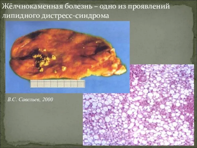 Жёлчнокаменная болезнь – одно из проявлений липидного дистресс-синдрома В.С. Савельев, 2000