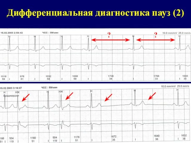 Дифференциальная диагностика пауз (2) ? ?