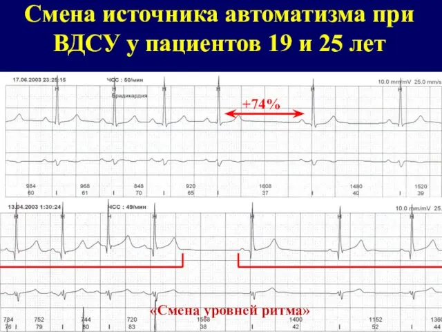 +74% «Смена уровней ритма» Смена источника автоматизма при ВДСУ у пациентов 19 и 25 лет