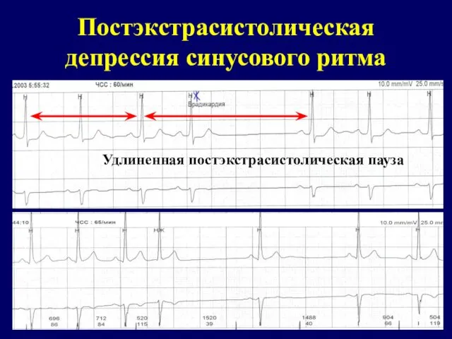 Постэкстрасистолическая депрессия синусового ритма Удлиненная постэкстрасистолическая пауза