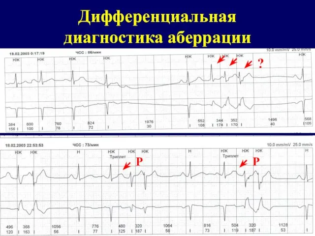 Дифференциальная диагностика аберрации ? Р Р