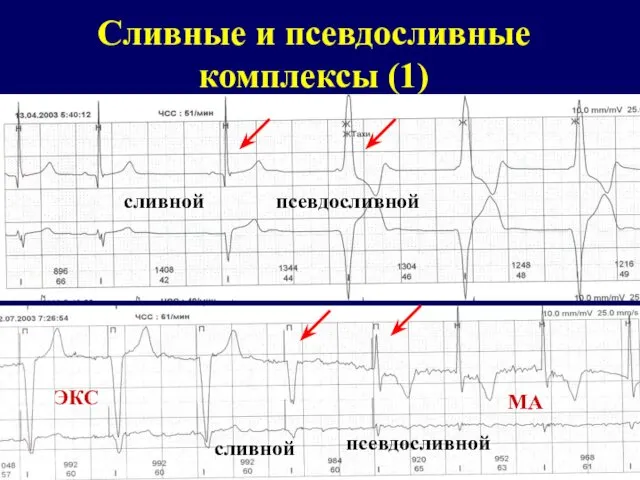 Сливные и псевдосливные комплексы (1) сливной псевдосливной сливной псевдосливной ЭКС МА