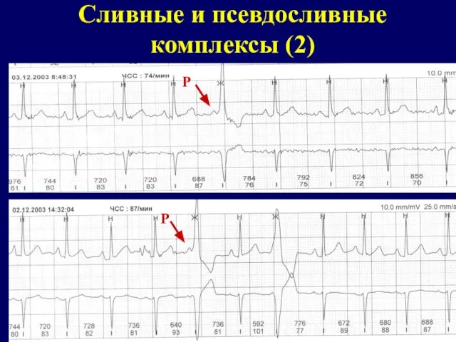 Сливные и псевдосливные комплексы (2) Р Р