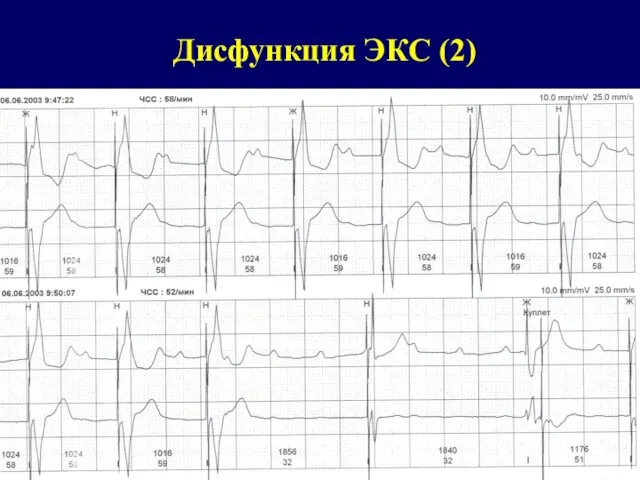 Дисфункция ЭКС (2)