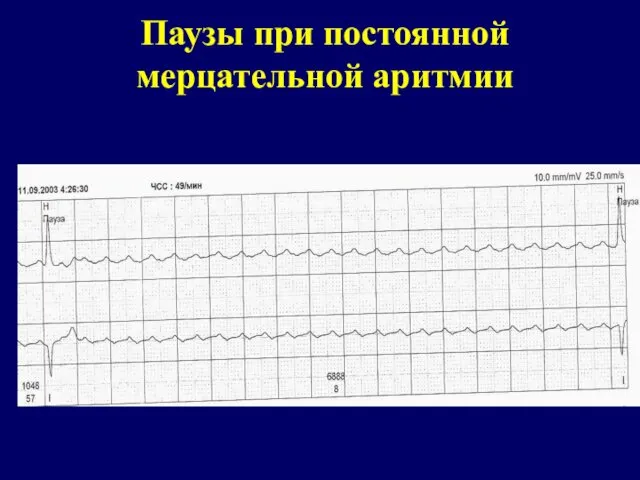 Паузы при постоянной мерцательной аритмии