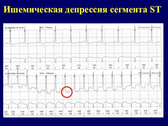 Ишемическая депрессия сегмента ST