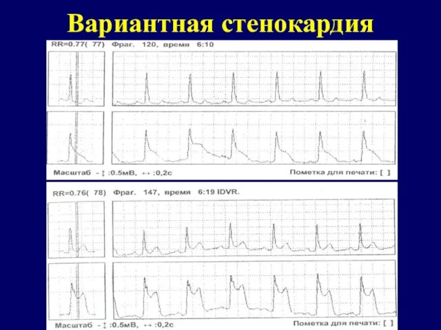 Вариантная стенокардия