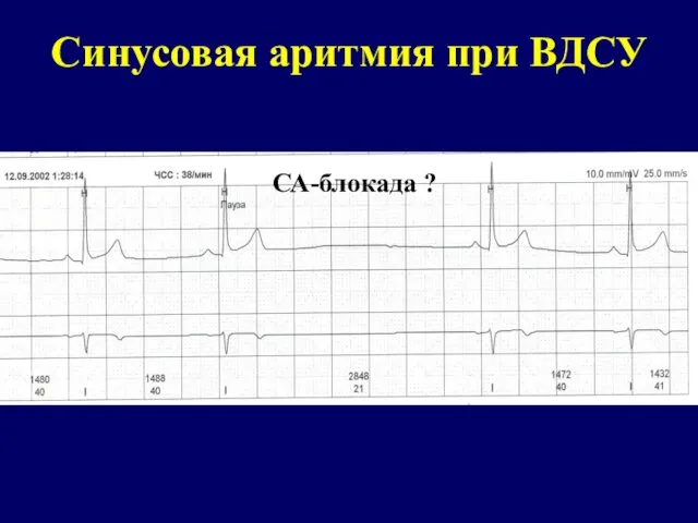 Синусовая аритмия при ВДСУ СА-блокада ?