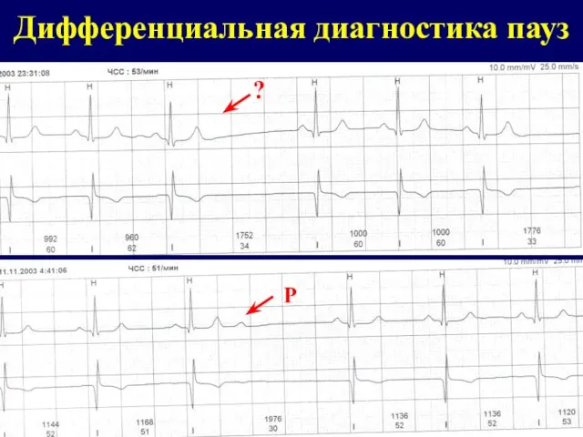 Дифференциальная диагностика пауз ? Р