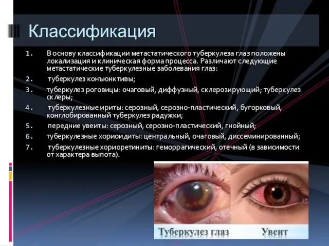 В основу классификации метастатического туберкулеза глаз положены локализация и клиническая форма