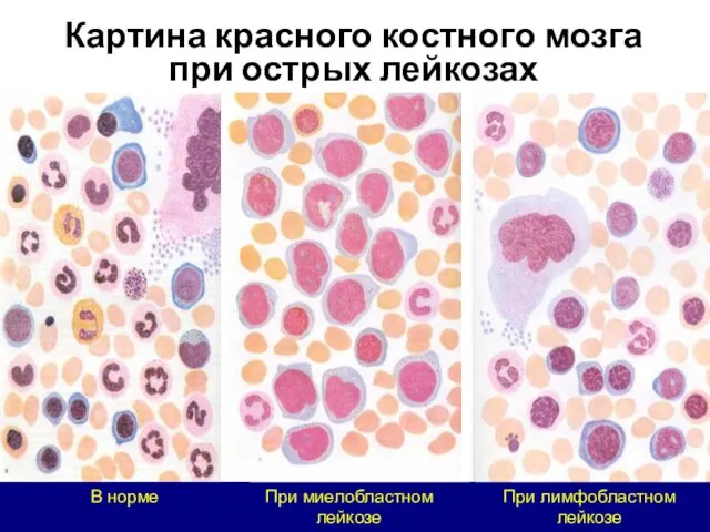 В норме При лимфобластном лейкозе При миелобластном лейкозе Картина красного костного мозга при острых лейкозах