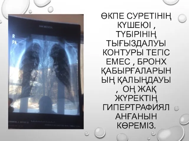 ӨКПЕ СУРЕТІНІҢ КҮШЕЮІ ,ТҮБІРІНІҢ ТЫҒЫЗДАЛУЫ КОНТУРЫ ТЕГІС ЕМЕС , БРОНХ ҚАБЫРҒАЛАРЫНЫҢ