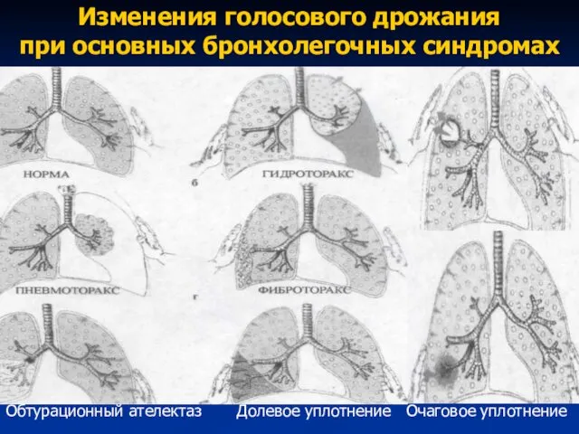 Изменения голосового дрожания при основных бронхолегочных синдромах Обтурационный ателектаз Долевое уплотнение Очаговое уплотнение