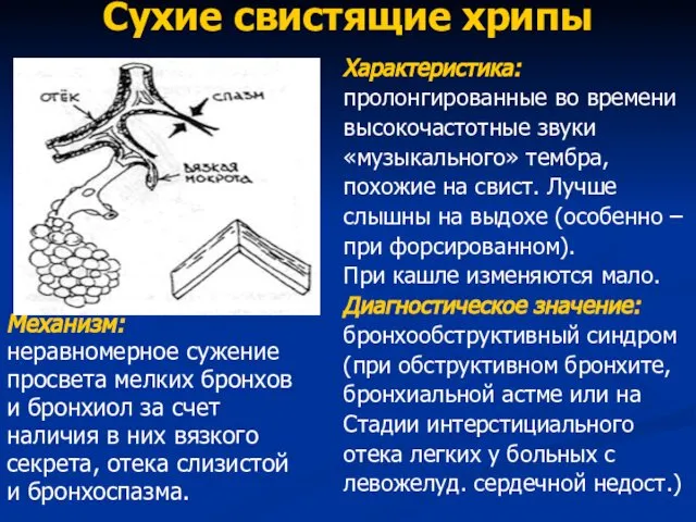 Сухие свистящие хрипы Механизм: неравномерное сужение просвета мелких бронхов и бронхиол