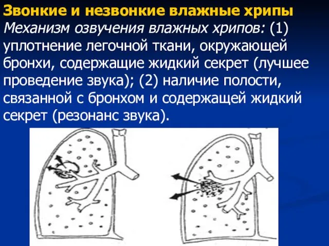 Звонкие и незвонкие влажные хрипы Механизм озвучения влажных хрипов: (1) уплотнение