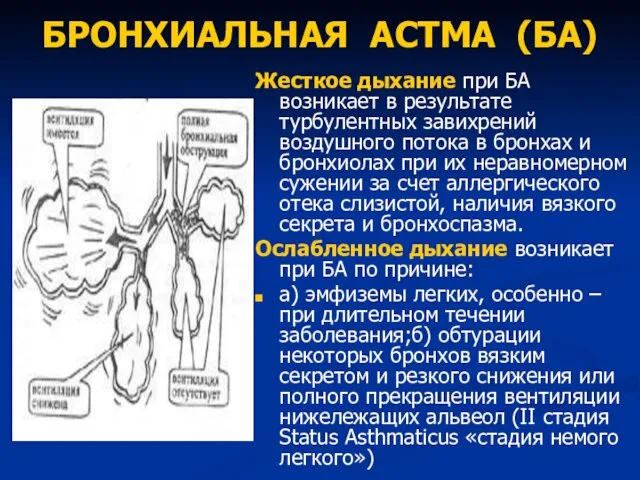 БРОНХИАЛЬНАЯ АСТМА (БА) Жесткое дыхание при БА возникает в результате турбулентных