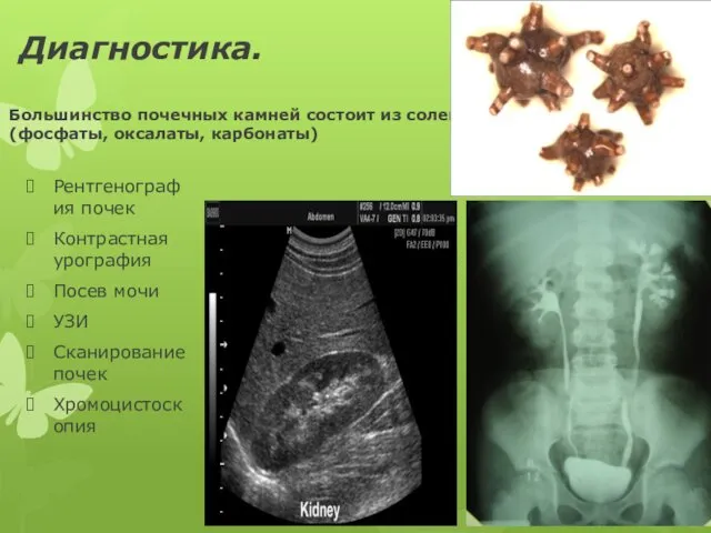 Диагностика. Большинство почечных камней состоит из солей кальция(фосфаты, оксалаты, карбонаты) Рентгенография