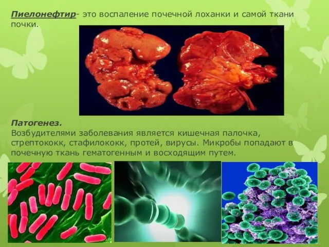 Пиелонефтир- это воспаление почечной лоханки и самой ткани почки. Патогенез. Возбудителями