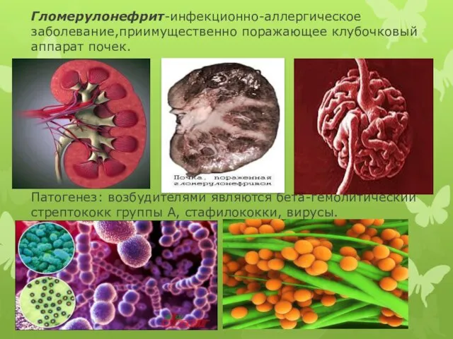 Гломерулонефрит-инфекционно-аллергическое заболевание,приимущественно поражающее клубочковый аппарат почек. Патогенез: возбудителями являются бета-гемолитический стрептококк группы А, стафилококки, вирусы.