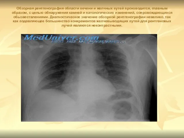Обзорная рентгенография области печени и желчных путей производится, главным образом, с