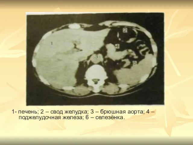 1- печень; 2 – свод желудка; 3 – брюшная аорта; 4