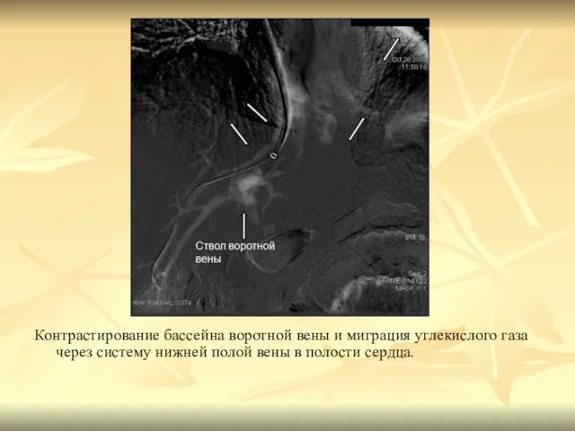 Контрастирование бассейна воротной вены и миграция углекислого газа через систему нижней полой вены в полости сердца.