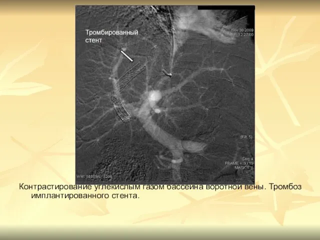 Контрастирование углекислым газом бассейна воротной вены. Тромбоз имплантированного стента.