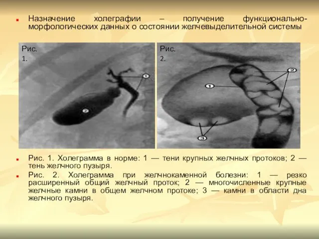 Назначение холеграфии – получение функционально-морфологических данных о состоянии желчевыделительной системы Рис.