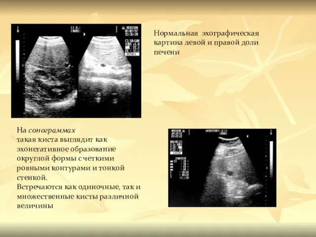 Нормальная эхографическая картина левой и правой доли печени На сонограммах такая