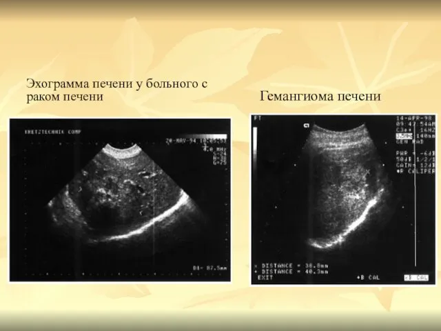 Эхограмма печени у больного с раком печени Гемангиома печени