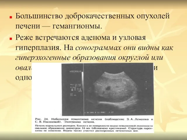 Большинство доброкачественных опухолей печени — гемангионмы. Реже встречаются аденома и узловая