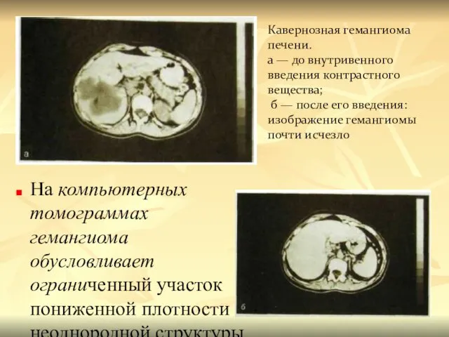 На компьютерных томограммах гемангиома обусловливает ограниченный участок пониженной плотности неоднородной структуры