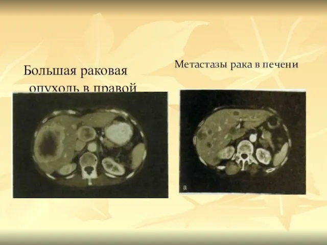 Большая раковая опухоль в правой доле. Метастазы рака в печени