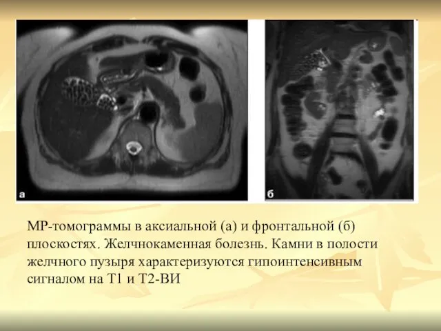 МР-томограммы в аксиальной (а) и фронтальной (б) плоскостях. Желчнокаменная болезнь. Камни