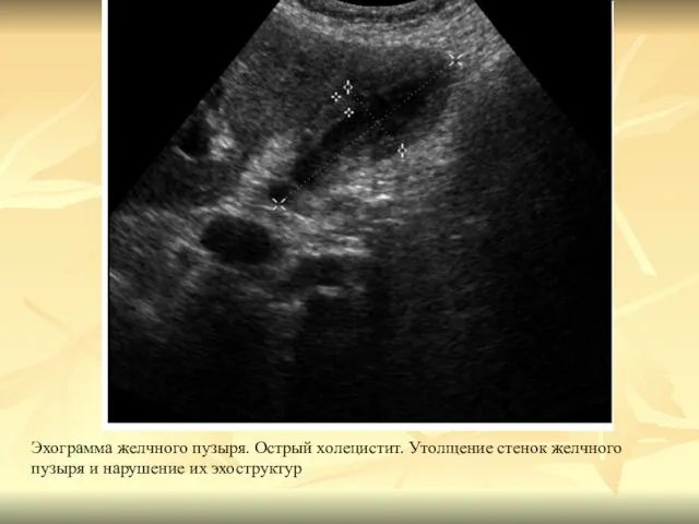 Эхограмма желчного пузыря. Острый холецистит. Утолщение стенок желчного пузыря и нарушение их эхоструктур