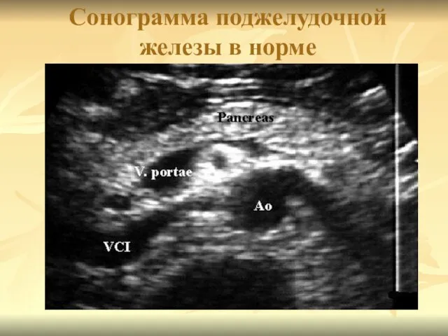 Сонограмма поджелудочной железы в норме